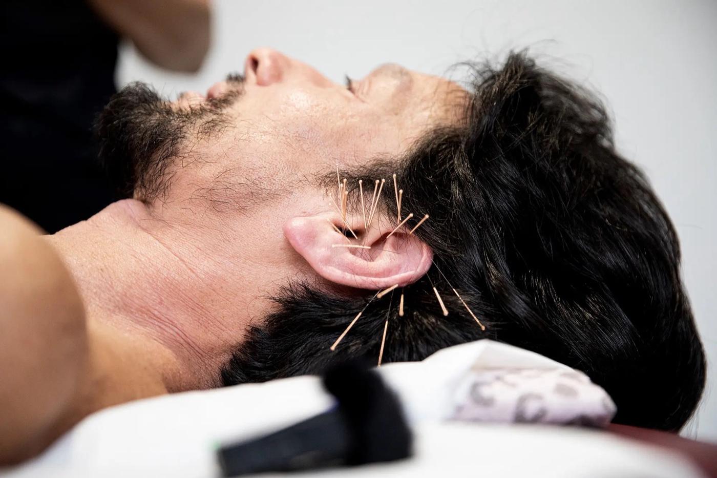 Aiguilles d'acupuncture posées sur le pavillon de l'oreille d'un patient allongé